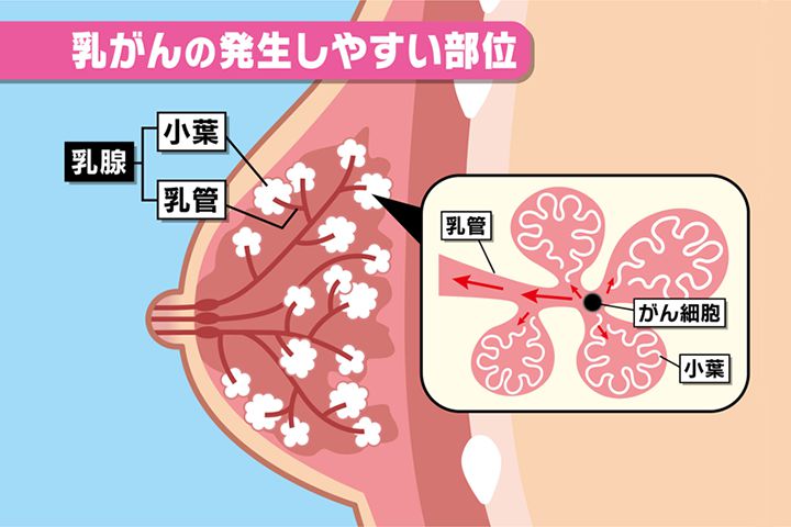 乳がんのしこりの大きさはどのくらいですか?